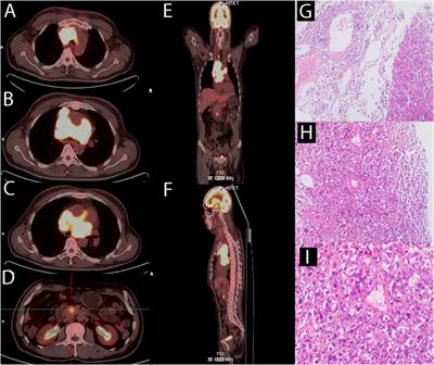 Frontiers | Relapsed/refractory Diffuse Large B Cell Lymphoma With ...